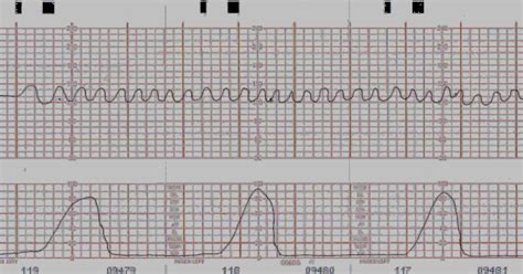 Obgyne Short Notes What Is The Sinusoidal Pattern Ctg