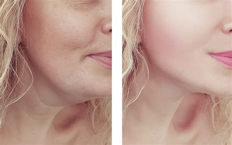 Effective Solutions To Say Goodbye To Double Chin