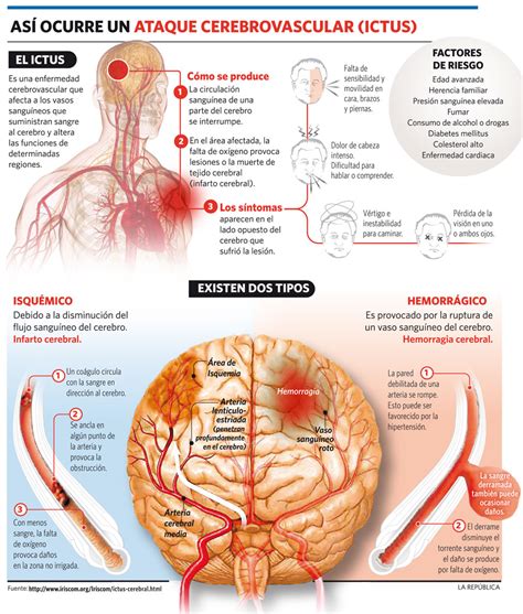 Medidas De Actuación En El Ictus O Ataque Cerebral Agudo Servicio And