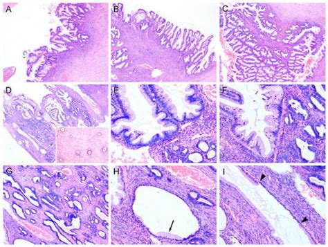 Diagnostics Free Full Text Mucinous Borderline Tumor Associated