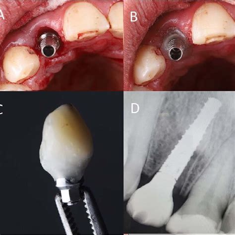 A Abutment Placement B Adding F Lowable Composite Around The