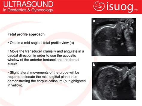 How To Image The Fetal Corpus Callosum Ppt