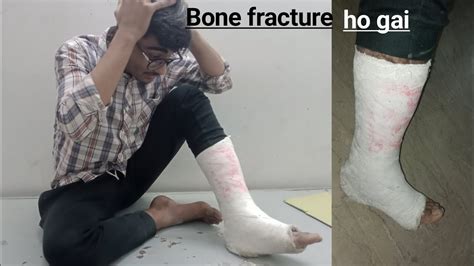 Ya Kiya Ho Gaya Bone Fracture Ho Gai Hospital Jana Para YouTube