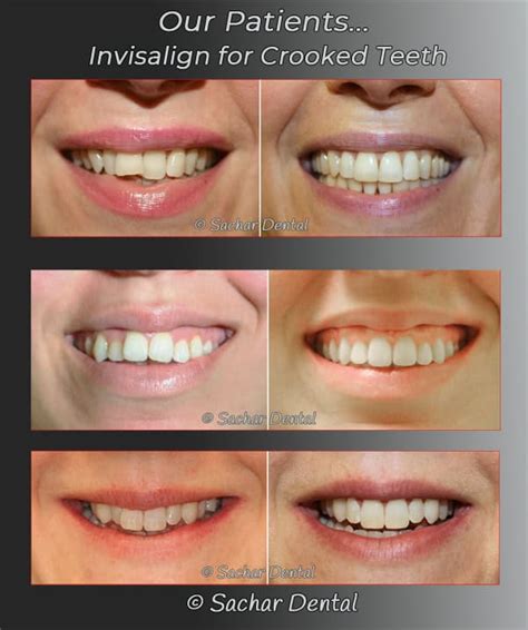 Dentist NYC Invisalign For Crooked Teeth Sachar Dental NYC