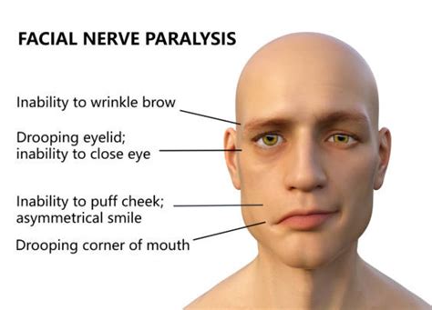 Bells Palsy The Paralyzed Face