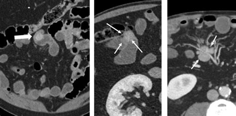 79 Year Old Male With Suspected Small Bowel Bleeding Underwent Download Scientific Diagram