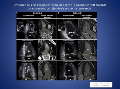 Echovar Eco Del Dia La Disyunci N Del Anillo Mitral