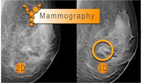 3D Mammography or Tomosynthesis | YGEIA IATRIKI APEIKONISI