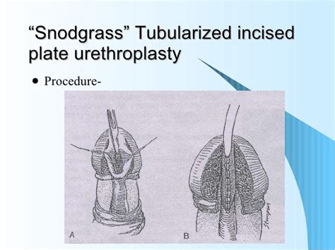 Hypospadias