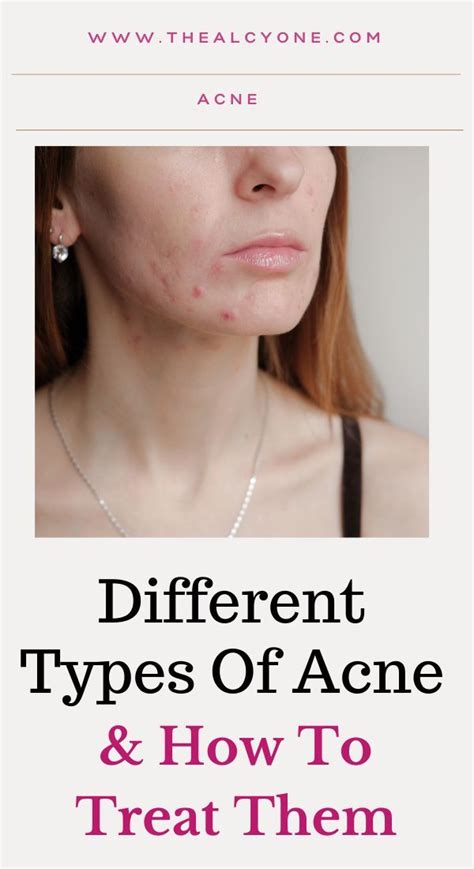 Top 10 Common Cause Of Acne And Treatments Artofit