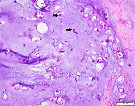 Chondroblastoma Pathology Outlines