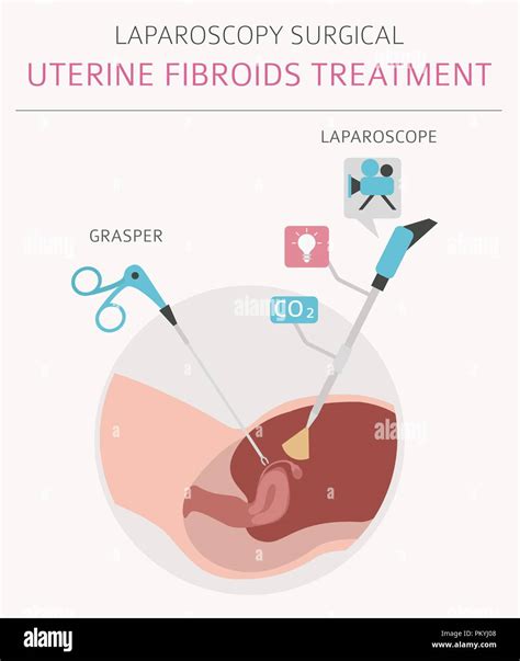 Uterine fibroids symptoms hi-res stock photography and images - Alamy