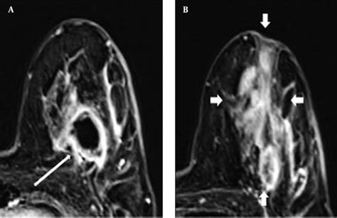 Magnetic Resonance Imaging Features Of Idiopathic Granulomatous