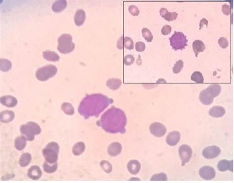 Acute Myeloid Leukemia Mimicking As Acute Megakaryoblastic Leukemia