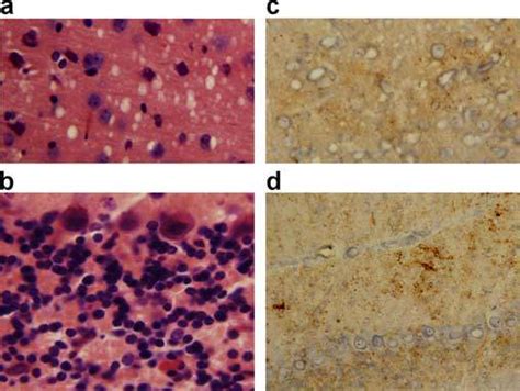 Histopathology And PrP Sc Deposition In The Brains Of SCJDMM1 Infected