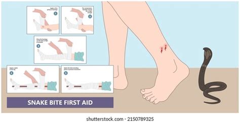 Snake Bite First Aid Poster