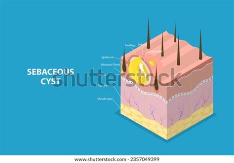 Sebaceous Cyst Concept: Over 7 Royalty-Free Licensable Stock Vectors & Vector Art | Shutterstock