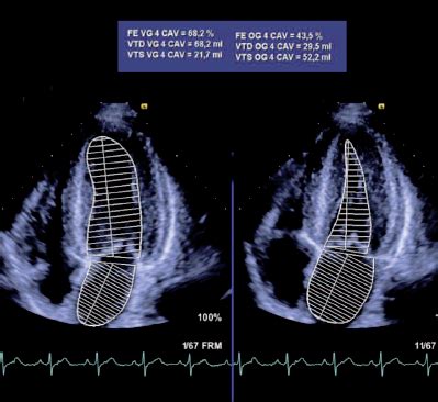 Insuffisance Cardiaque Fraction D Jection Pr Serv E Valuation