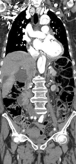 Brown Hospital Medicine On Twitter A 75 Year Old Woman With History