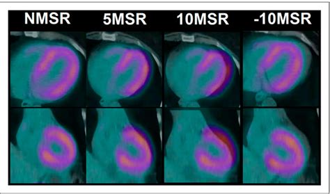 Figure 1 From Cardiac PET CT Misregistration Causes Significant Changes