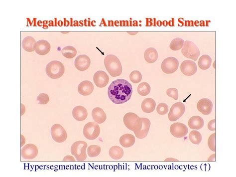 PPT - The Megaloblastic Anemias: Vitamin B 12 & Folate Deficiency ...