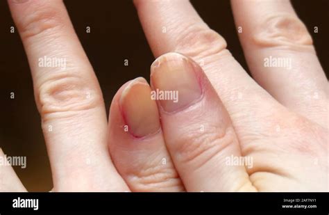 Cracked Fingernails With Brittle Splitting And Peeling Nails Stock