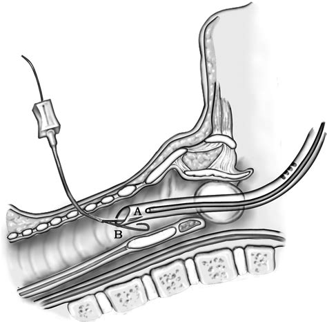 Translaryngeal Tracheotomy Operative Techniques In Otolaryngology