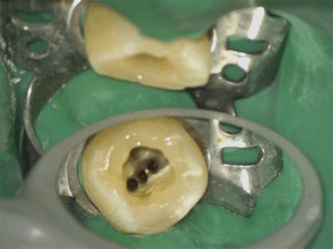 Magnified View Of Pulpal Floor In Tooth 36 After Retreatment Showing Download Scientific