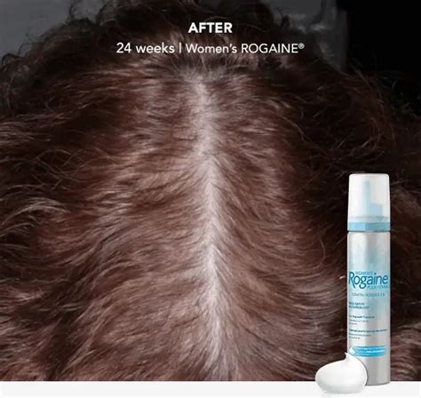 ROGAINE® for Women: Minoxidil Hair Regrowth Foam & Solution | ROGAINE®