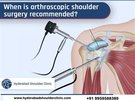 When Is Arthroscopic Shoulder Surgery Recommended Shoulder Clinic