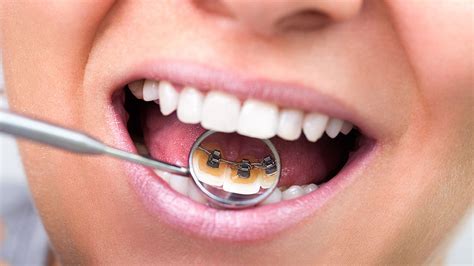 Invisible Teeth Straightening Braces In Newcastle Gosforth Dental Surgery