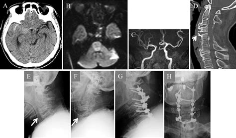 Diffuse Idiopathic Skeletal Hyperostosis Foot