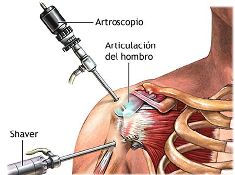 Artroscopia De Hombro Cirugia De Columna En Matamoros