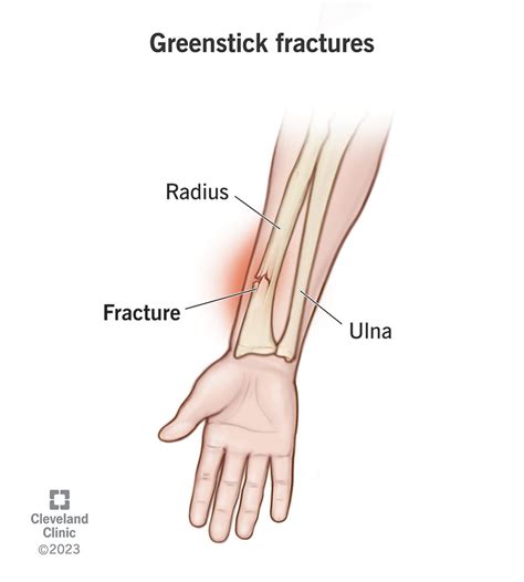 Greenstick Fractures Symptoms Treatment