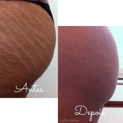 Camuflagem De Estrias Antes E Depois - Camuflagem de Cicatriz e Estria | Estética Avançada em Niterói | Botox ...