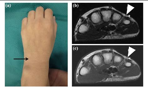 Figure 1 From Ulnar Sided Wrist Pain Due To Radial Bifurcation Of The Extensor Digiti Minimi