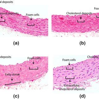 Illustrative Images Showing Atherosclerotic Lesions After Of The