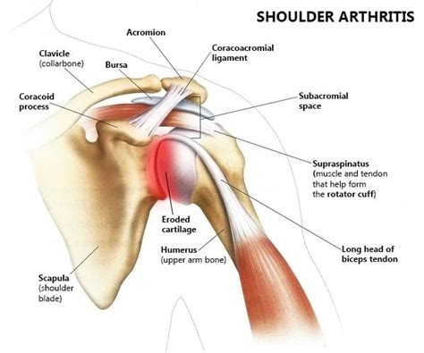 Shoulder Arthritis Specialists in NYC