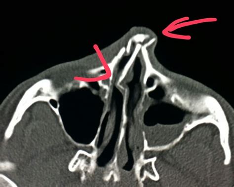 Nasal Bone Anatomy Ct Radiology : Technology and Techniques in ...