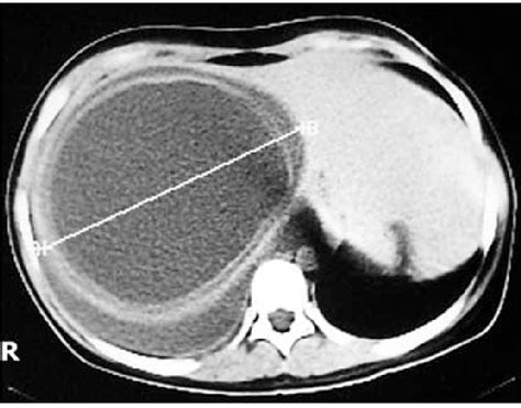 Computed Tomography Scan Of A Patient Disclosing A Huge Concomitant