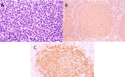 Morphology Of Lymph Node Biopsy At Initial Presentation A