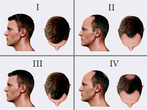 Male Pattern Baldness Stages Renew Physical Therapy