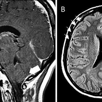 Lumbar MRI Shows Dural Ectasia A And An Anterior Meningocele From The