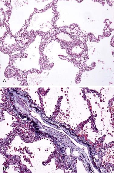 Pathology Malignant And Interstitial Lung Diseases Thoracic Key