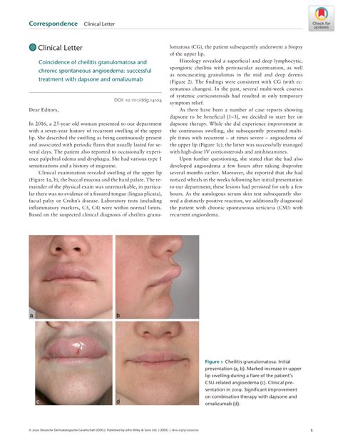 Pdf Coincidence Of Cheilitis Granulomatosa And Chronic Spontaneous