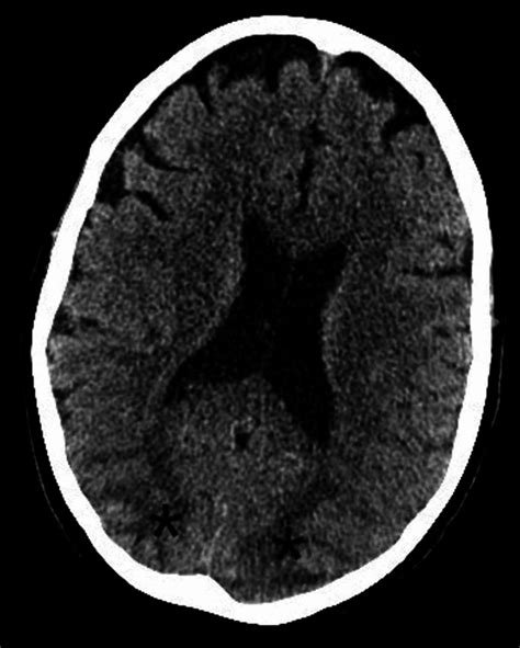 Cureus Persistent Cortical Blindness Following Posterior Reversible | Hot Sex Picture