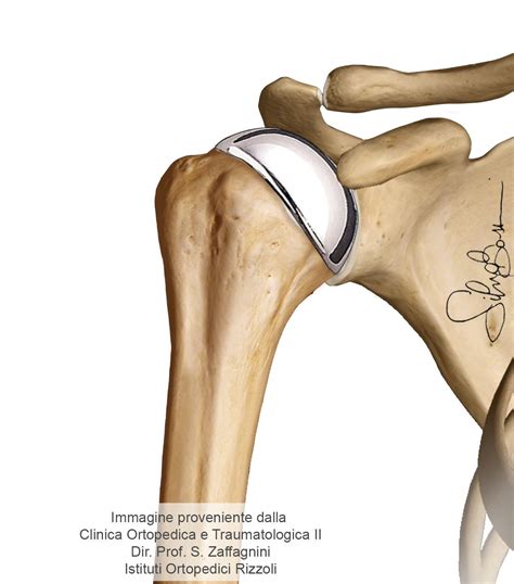 Protesi Di Spalla Intervento Marcheggiani Muccioli