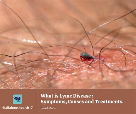 What Is Lyme Disease Symptoms Causes And Treatments Lyme Disease Disease Lyme Disease