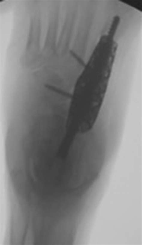 Intraoperative Fluoroscopic Anteroposterior Image Of Final Position Of