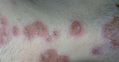 Infantigo Rash ~ Infantigo Pictures Contagious Causes Symptoms Treatment